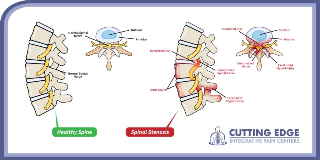 Spine pain, lumbar spinal stenosis